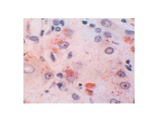 wilson-disease-stain-for-copper.jpg